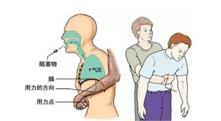 海姆利克急救法体感方法1：成人立位腹部冲击法